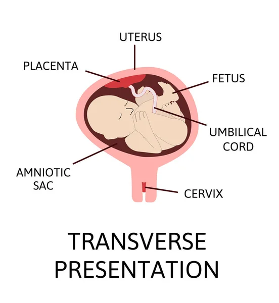 임신중에 자궁내의 위치가 다르다 Cephalic Breech Transverse Whique 거짓말 그림을 — 스톡 벡터
