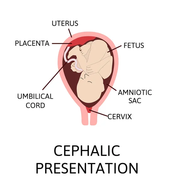 Verschillende Baby Posities Baarmoeder Tijdens Zwangerschap Kefalic Breech Dwars Oblique — Stockvector