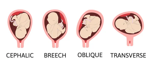 Verschillende Baby Posities Baarmoeder Tijdens Zwangerschap Kefalic Breech Dwars Oblique — Stockvector