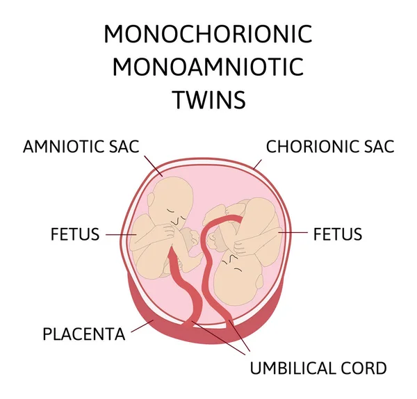 쌍둥이와 복부의 해부학이요 설계의 종류의 그래픽 쌍동이 의의학적 삽화와 장품을 — 스톡 벡터