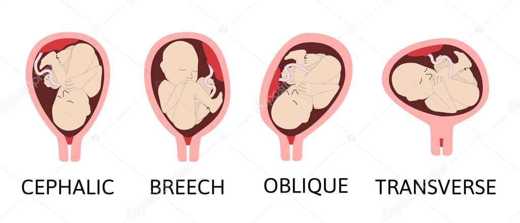 Different baby positions in the uterus during pregnancy. Cephalic, Breech, transverse, Oblique lies. Colored medical vector illustration. Fetus with umbilical cord and placenta.