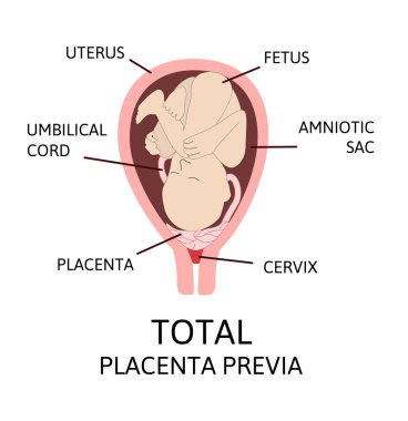 Hamilelik sırasında farklı plasenta bölgeleri. Büyük ve Normal plasenta previa, toplam ve kısmi.