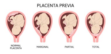 Different Placental Locations During Pregnancy. Major and Normal placenta previa, total and partial. clipart