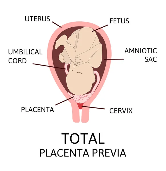 Olika placentaplatser under graviditeten. Större och normal placenta previa, helt och delvis. — Stock vektor