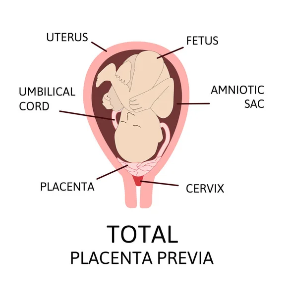 Diferentes ubicaciones placentarias durante el embarazo. placenta previa mayor y normal, total y parcial . — Vector de stock