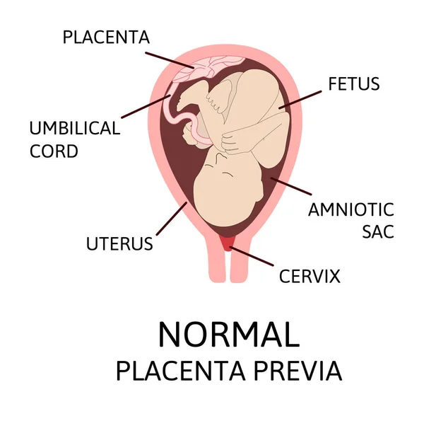 Verschillende placentale locaties tijdens de zwangerschap. Major en Normal placenta previa, geheel en gedeeltelijk. — Stockvector