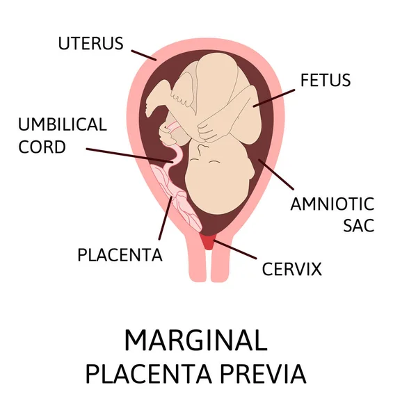 임신중 다른 태반 위치에서 요. 주요 및 정상 태반 이 전체 및 부분적으로 형성되어 있다. — 스톡 벡터