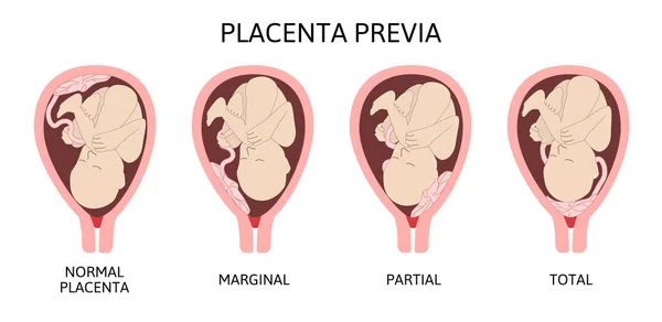 Diverse posizioni placentarie durante la gravidanza. Placenta previa maggiore e normale, totale e parziale . — Vettoriale Stock