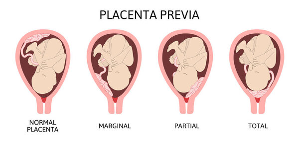 Different Placental Locations During Pregnancy. Major and Normal placenta previa, total and partial.