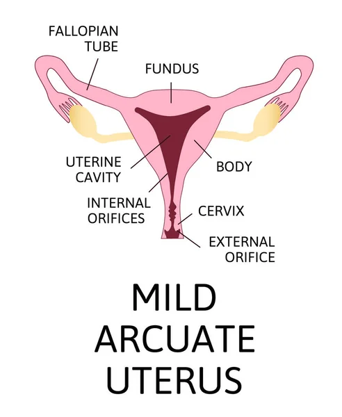 Forma Del Útero Órgano Reproductor Femenino Normal Arcuato Leve Moderado — Archivo Imágenes Vectoriales
