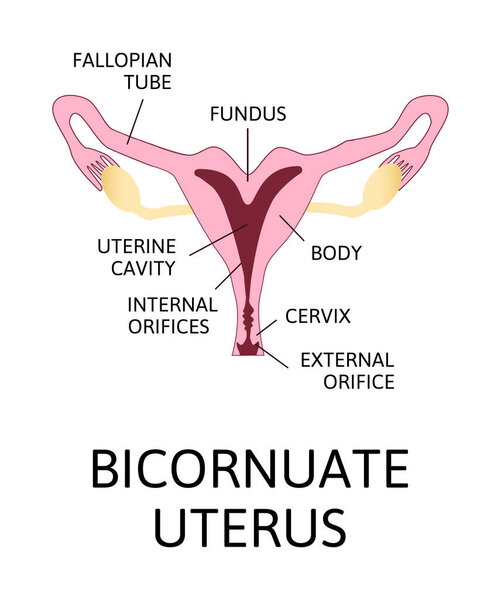 The shape of the uterus, the female reproductive organ. normal, mild arcuate, moderate, severe, bicornuate. Colored medical vector illustration isolated on white.