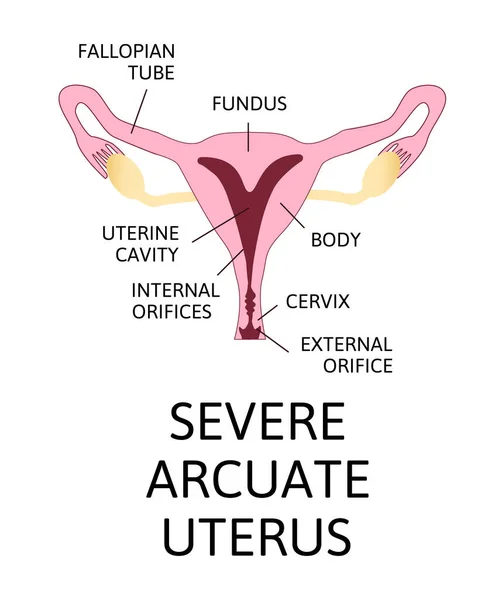 Forma Del Útero Órgano Reproductor Femenino Normal Arcuato Leve Moderado — Archivo Imágenes Vectoriales