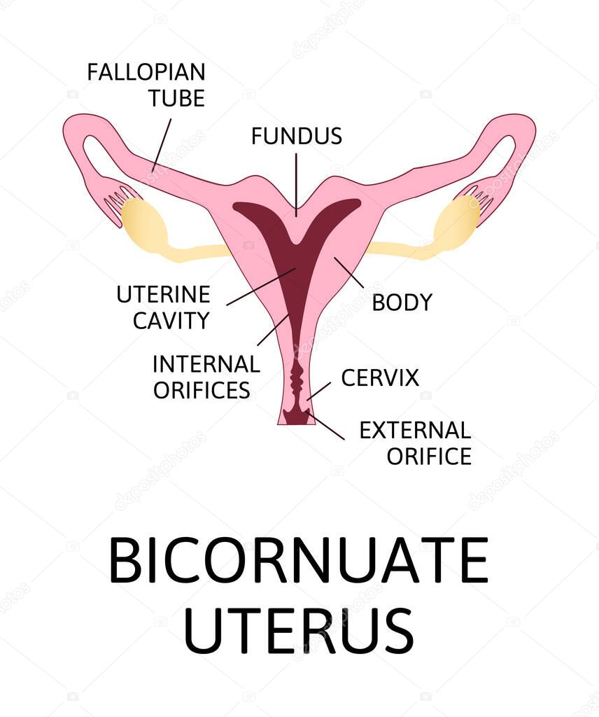 The shape of the uterus, the female reproductive organ. normal, mild arcuate, moderate, severe, bicornuate. Colored medical vector illustration isolated on white.