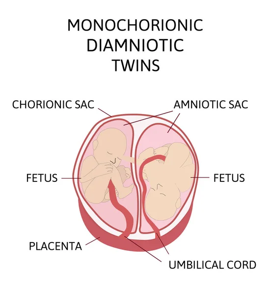 Anatomie Van Buik Met Tweeling Twin Types Infographic Elementen Plat — Stockvector