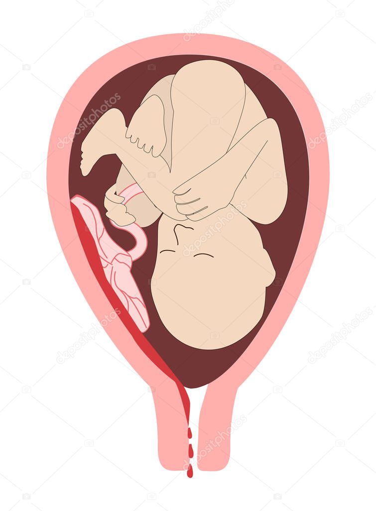 child in the womb. The detachment of the placenta, placental abruption. Vaginal bleeding. Dangerous complication of pregnancy, 