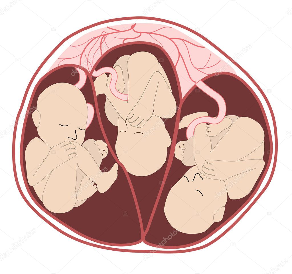 triplets in utero from an anterior. three fetuses in the uterus. Multiple pregnancy. risk factor. Separate amniotic sacks, one placenta. Three umbilical cords. Vector medical illustration isolated on white background