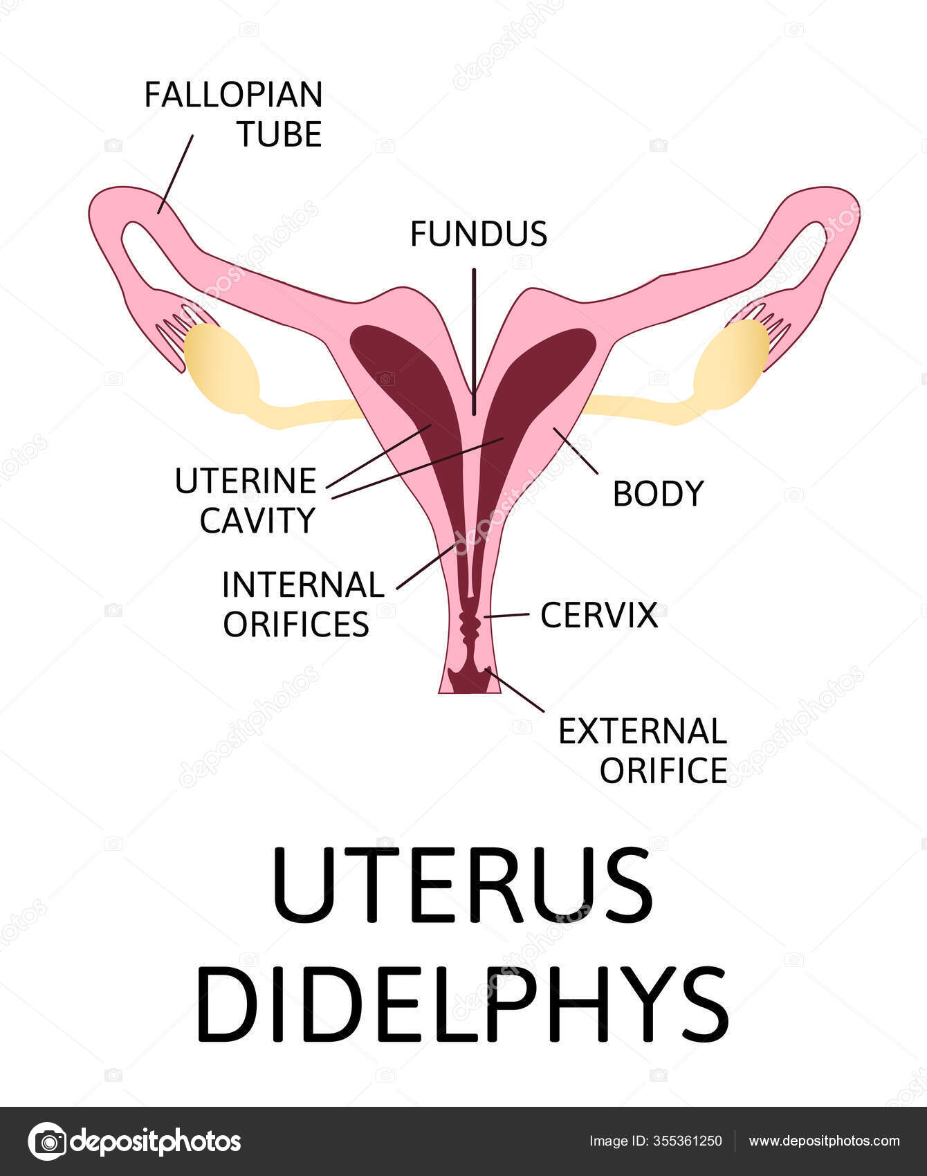 Uterus Didelphys