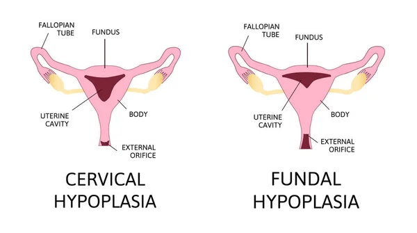 Gebärmutterhypoplasie Naiver Uterus Oder Infantiler Uterus Fundale Hypoplasie Zervikale Hypoplasie — Stockvektor