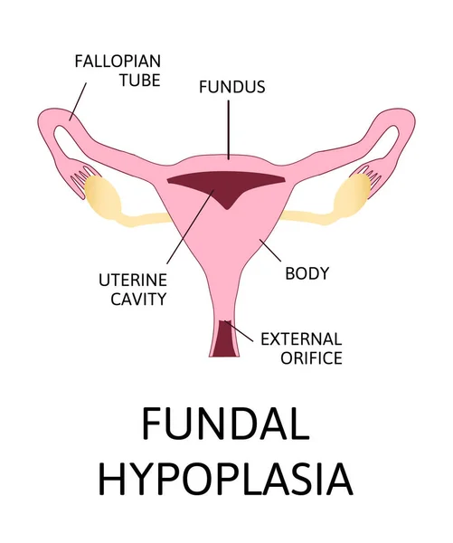 Uterine Hypoplasia Naive Uterus Infantile Uterus Fundal Hypoplasia Cervical Hypoplasia — Stock Vector