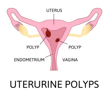 Uterine polyps. Human realistic uterus. Anatomy illustration. clipart