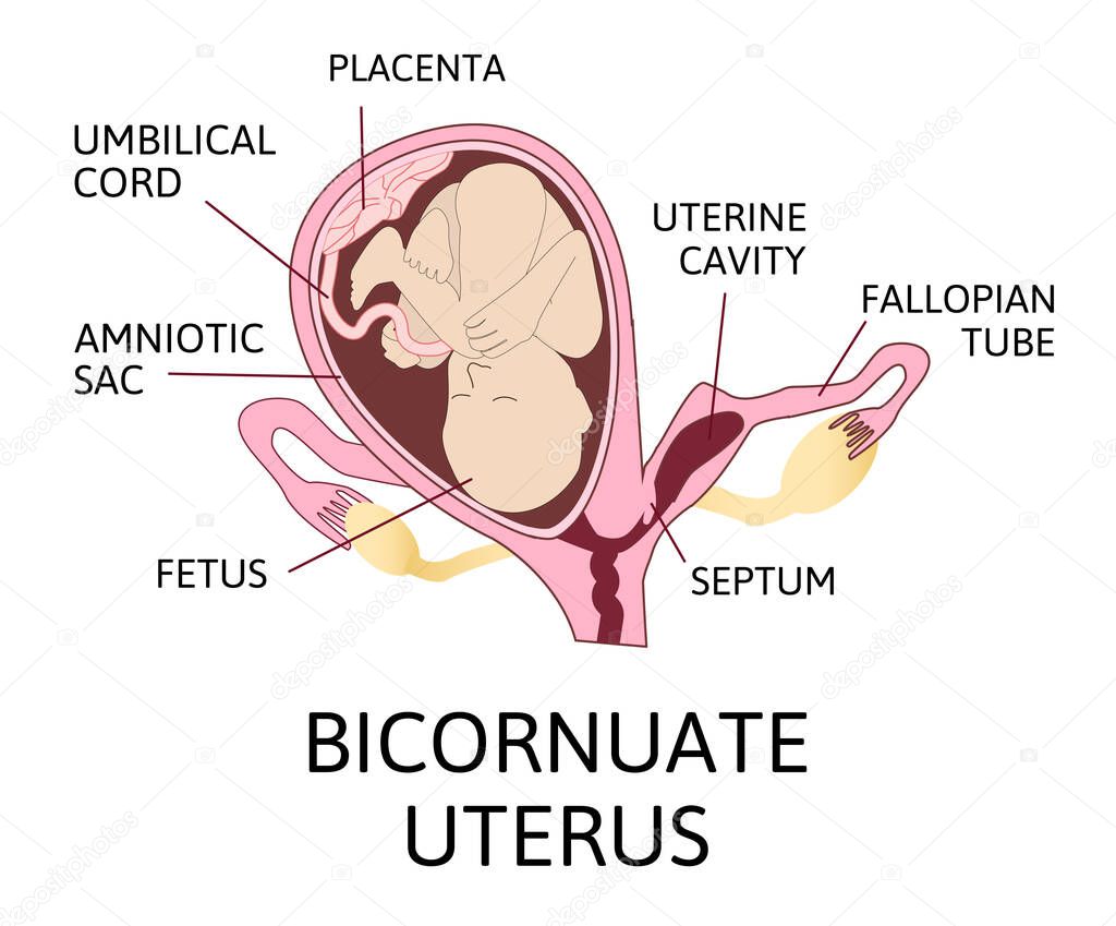 Bicornuate uterus and pregnancy. One uterine with fetus, child. Second uterine cavity is empty and separeted with septum. Pathology pregnancy. uterus bicornis. Vector illustration