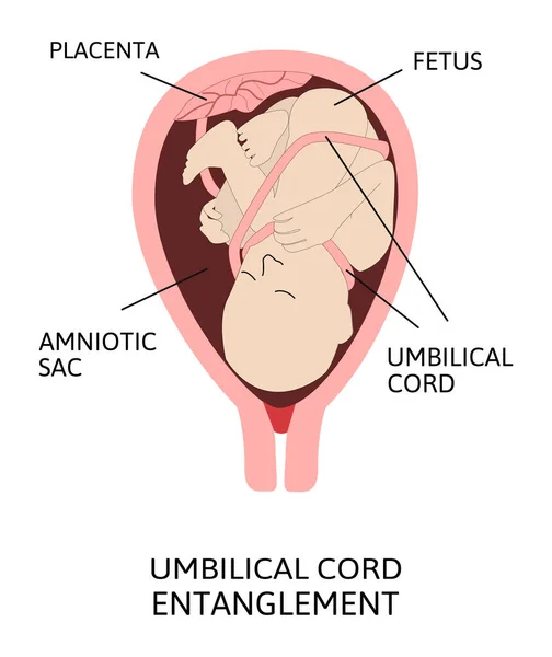 Navelstreng Verstrengeling Vectorillustratie Van Verstrengeling Van Navelstreng Rond Foetus Placenta — Stockvector