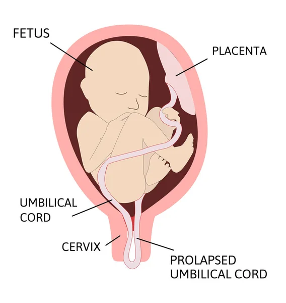 Prolapso Del Cordón Umbilical Cordón Umbilical Sale Del Útero Con — Vector de stock