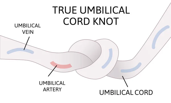 Um verdadeiro nó de cordão umbilical. o cordão umbilical forma um nó dentro do útero. Perigo para a criança . — Vetor de Stock