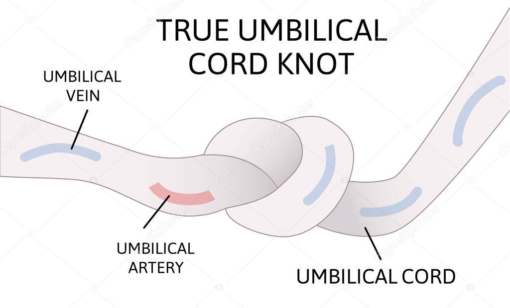 True umbilical cord knot. umbilical cord forms a knot inside the womb. Danger for child.