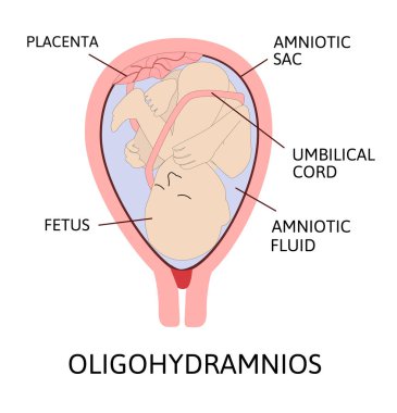 Oligohydramnios, amniyotik sıvı eksikliği. Hamileliğin bazı kısımları çizgi ile işaretlenmiştir.