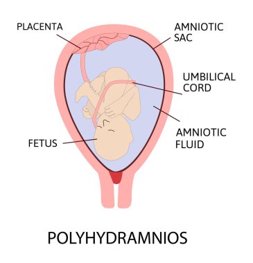 Polyhydramnios. excess of amniotic fluid in the amniotic sac. clipart