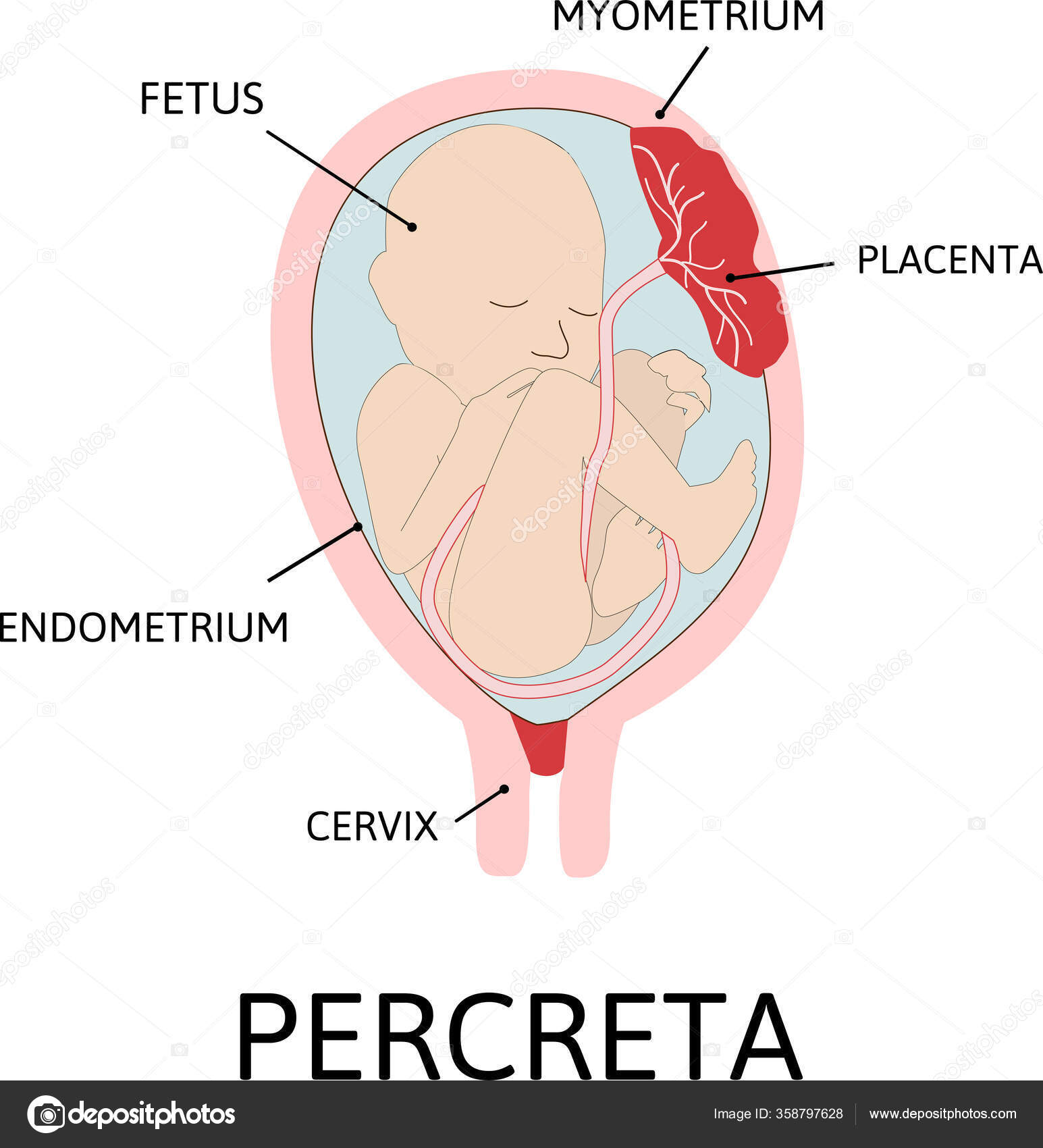 Placenta Percreta Parte Placenta Liga Anormalmente Miométrio Grau Fixação  Anormal Vetor de ©Betty1994 358797628, image size:1545x1700