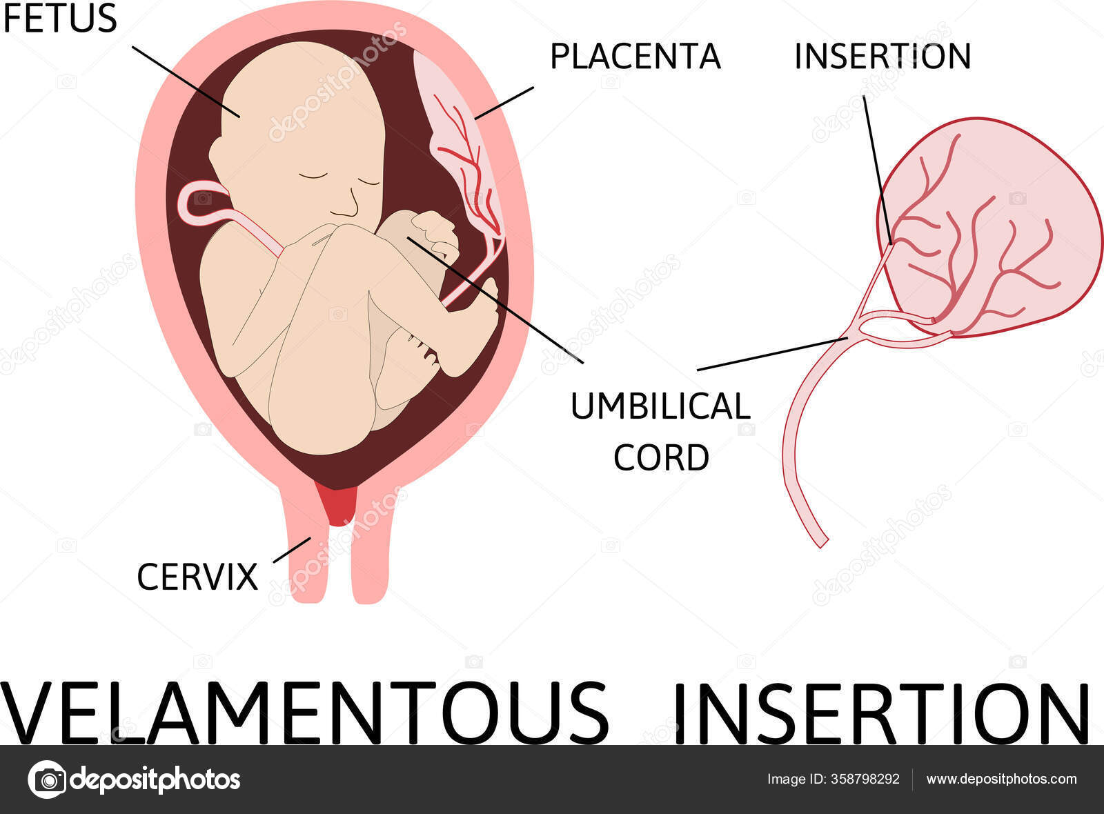 Velamentous Insertion Umbilical Cord Insertion Site Varies Center Stock
