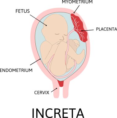 Plasenta artışı. Plasentanın bir kısmı miyometriyuma anormal bir şekilde bağlanıyor. Anormal bağlanma derecesi derinliğe göre çizilmiş. renkli tıbbi vektör çizimi