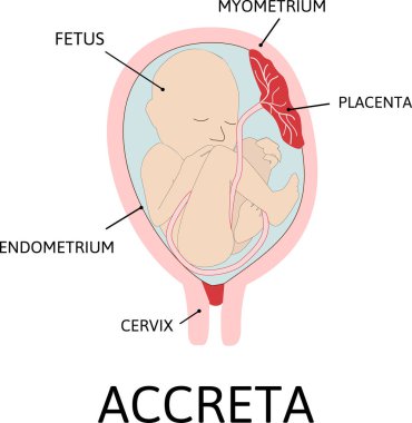 Plasenta oluşumu. Plasentanın bir kısmı miyometriyuma anormal bir şekilde bağlanıyor. Anormal bağlanma derecesi derinliğe göre çizilmiş. renkli tıbbi vektör çizimi