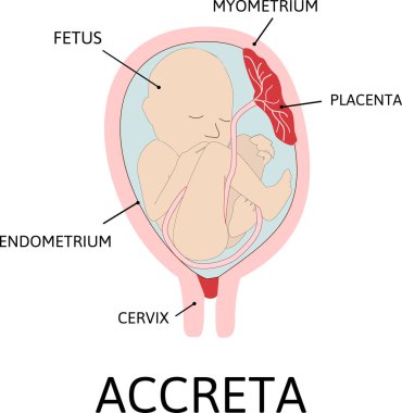 Placenta accreta. part of placenta attaches abnormally to the myometrium. grade of abnormal attachment illustrated according to the depth Accrete. colored medical vector illustration clipart
