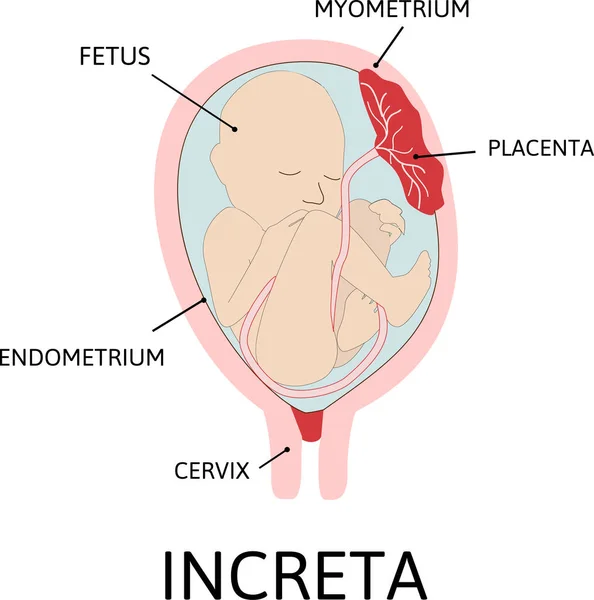 Placenta Increta Parte Placenta Liga Anormalmente Miométrio Grau Fixação Anormal — Vetor de Stock
