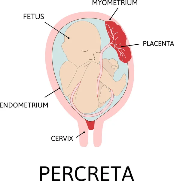 Placenta Percreta Parte Placenta Liga Anormalmente Miométrio Grau Fixação Anormal — Vetor de Stock