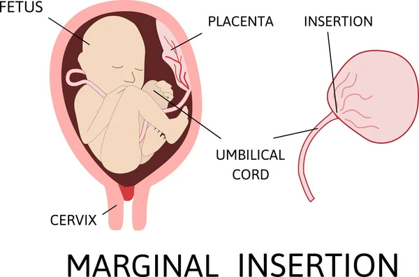 Inserimento Marginale Del Cordone Ombelicale Sito Inserimento Varia — Vettoriale Stock