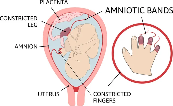 Bandes Amniotiques Foetus Est Empêtré Dans Des Bandes Amniotiques Fibreuses — Image vectorielle
