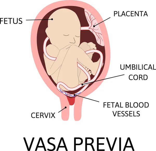 프라에 비아는 태아의 혈관이다 — 스톡 벡터