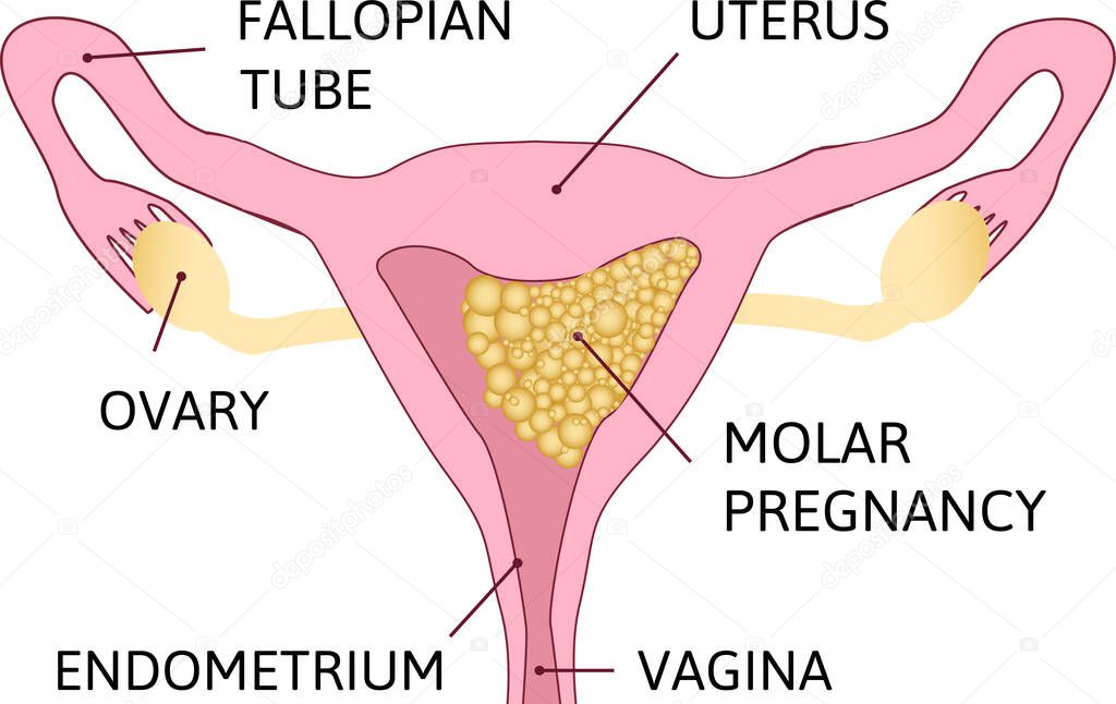 Molar pregnancy, abnormal form of pregnancy. Many grapes in uterine cavity. Human realistic uterus. Anatomy illustration. Colored image, white background.