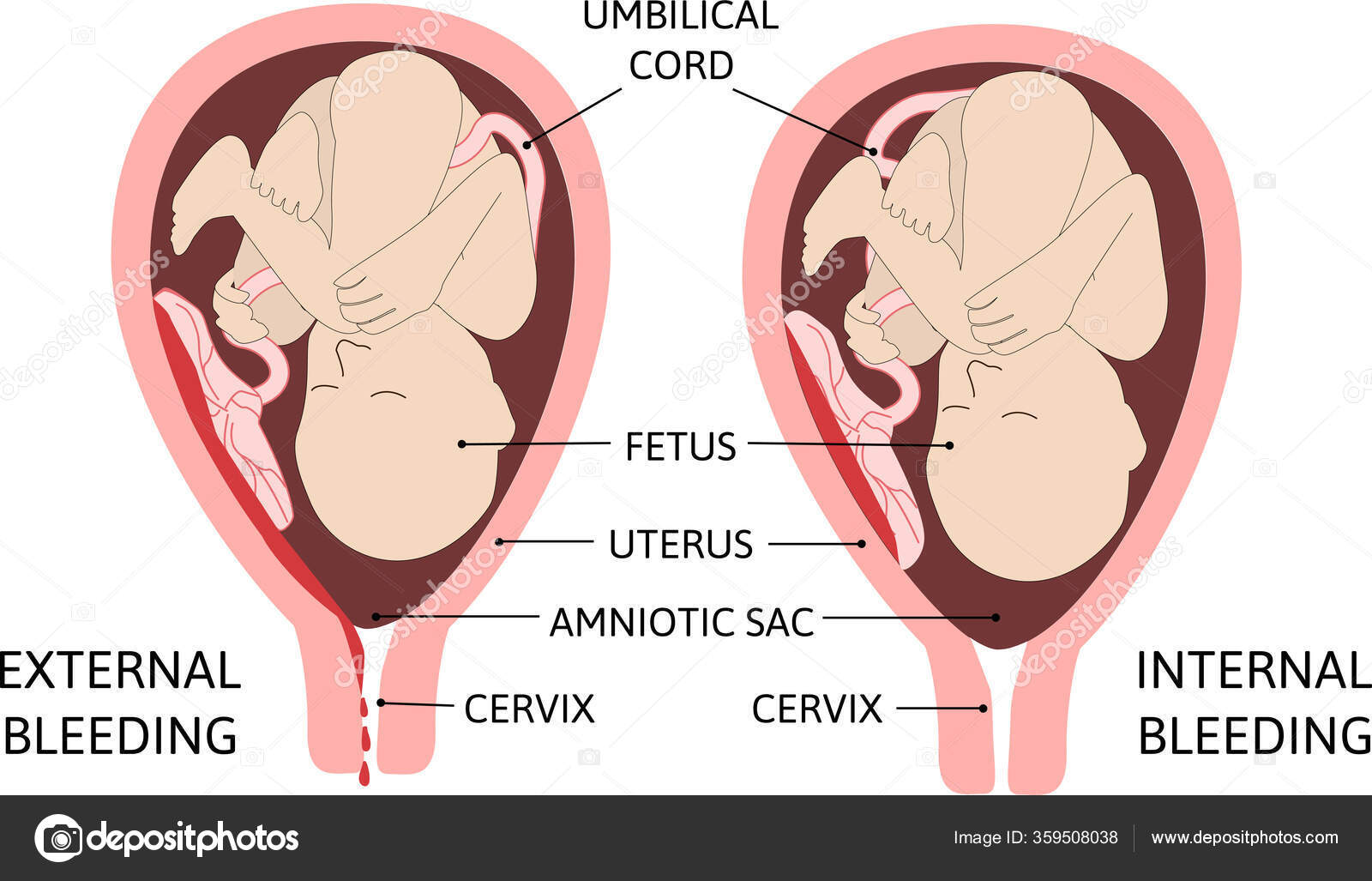 Barn Livmoren Vaginal Blødning Utvendig Innvendig stockvektor © Betty1994  #359508038, image size:1600x1027