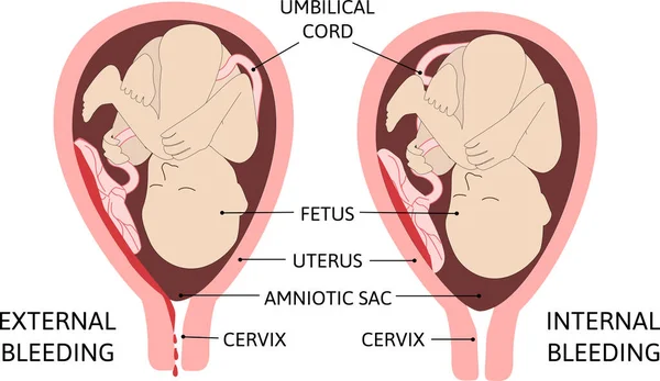 Child Womb Vaginal Bleeding External Internal — Stock Vector