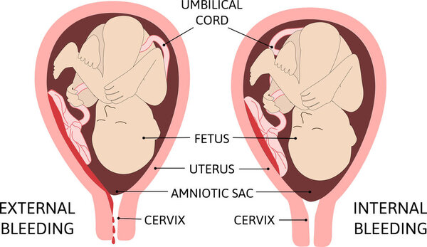 child in the womb. Vaginal bleeding external and internal