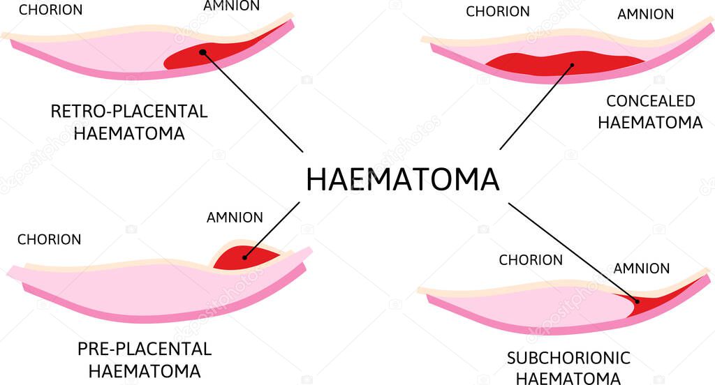 Placental haematoma. blood clots that arise from the placenta. Depending on their location it is retro-placental, subchorionic or preplacental. Vector medical illustration isolated on white.