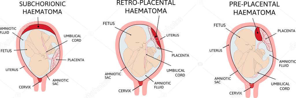 Placental haematoma. blood clots that arise from the placenta. 