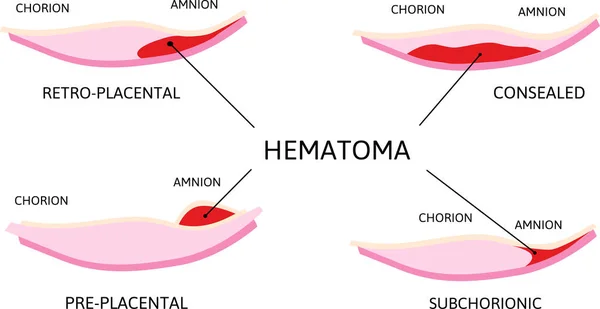 Placental Hematoma Blood Clots Arise Placenta Depending Location Retro Placental — Stock Vector