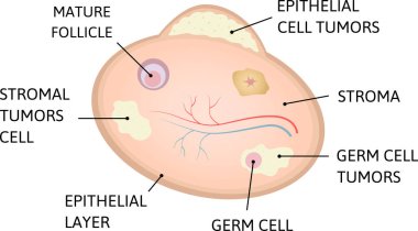 Ovarian cancer. cancer of epithelial layer,  germ cell, stromal tumors cell. clipart