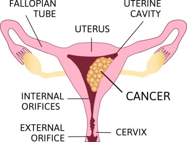 Rahmin Endometrium Dokusunda Kanser Tümörü Hücreleri olan Rahim Kanser Vektörü Posteri ya da Çizelgesi. En yaygın kadın üreme sistemi anatomik illüstrasyonunun Onkolojik Hastalığı.